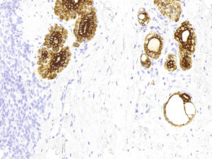 Breast. Needle biopsy. Negative immunohistochemical staining for Cytokeratin 7 in tumor cells. Notice positive staining of benign breast structures (epithelial and myoepithelial cells). CK7.