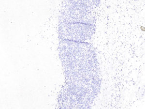 Breast. Needle biopsy. Negative immunohistochemical staining for Cytokeratin 20 in tumor cells. CK20.