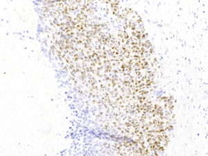 Breast. Needle biopsy. Weak to moderate positive staining for Estrogen Receptor in the nuclei of tumor cells. ER.