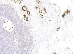 Breast. Needle biopsy. Negative staining of tumor cells for GATA3 and positive staining of benign breast structures. GATA3.