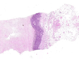 Breast. Needle biopsy. Mostly necrotic tumor with small rim of preserved viable tumor tissue at the periphery. H&E.