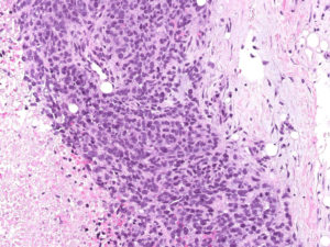 Breast. Needle biopsy. Mostly necrotic tissue with small rim of preserved viable tumor tissue at the periphery. Higher magnification. H&E.