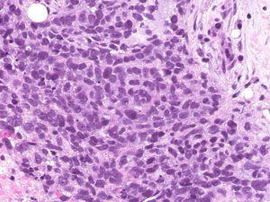 Breast. Needle biopsy. Highest magnification of preserved viable tumor tissue. H&E. 40x.