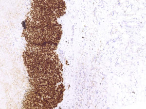 Breast. Needle biopsy. Strong positive staining in the nuclei of all viable tumor cells. PAX8.
