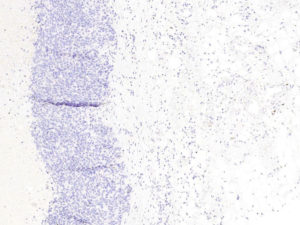 Breast. Needle biopsy. Negative staining of all tumor cells. Synaptophysin.