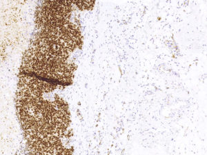 Breast. Needle biopsy. Strong positive staining in the nuclei of all viable tumor cells and cytoplasmic staining of endothelial cells. WT1 (clone 6F-H2 against N-terminal).