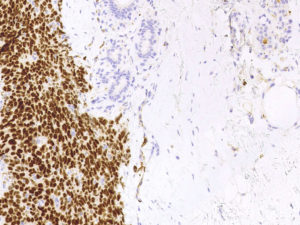 Breast. Needle biopsy. Strong positive staining in the nuclei of all viable tumor cells. Higher magnification. WT1 (clone 6F-H2 against N-terminal).